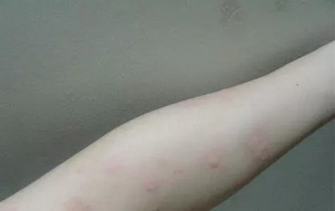 吃什么能治疗荨麻疹
