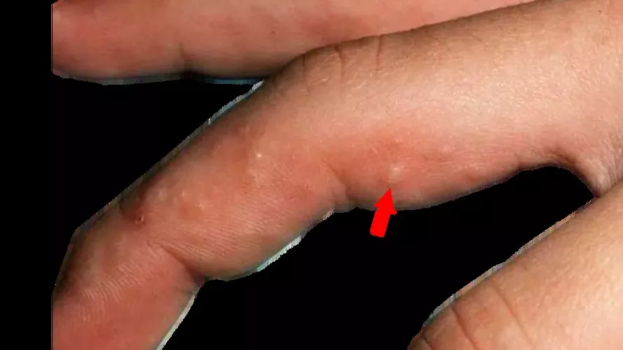 手上汗疱疹不能吃什么